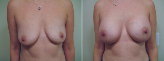 Before and after Breast Augmentation by Dr. David W. Allison, Patient 6139