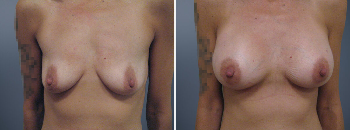 Before and after Breast Augmentation by Dr. David W. Allison, Patient 6145