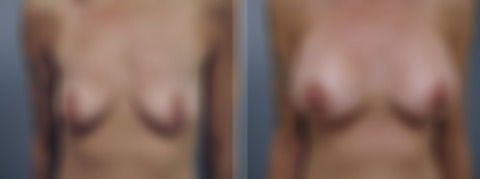 Before and after Breast Augmentation by Dr. David W. Allison, Patient 6145