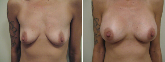 Before and after Breast Augmentation by Dr. David W. Allison, Patient 6145