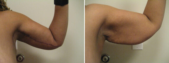 Before and after Arm Liposuction by Dr. David W. Allison, Patient 6149