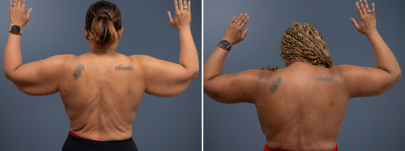 Before and after Arm Liposuction by Dr. David W. Allison, Patient 6149