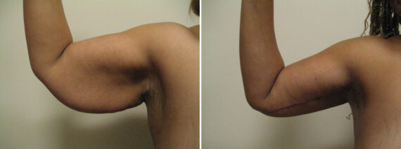Before and after Arm Liposuction by Dr. David W. Allison, Patient 6149