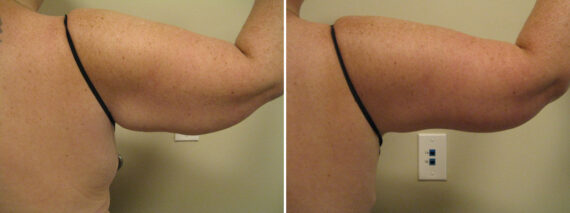Before and after Arm Liposuction by Dr. David W. Allison, Patient 6159