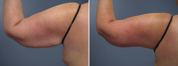 Arm Liposuction before and after photos in Princeton, NJArm Liposuction Before and After Photos in Princeton, NJ