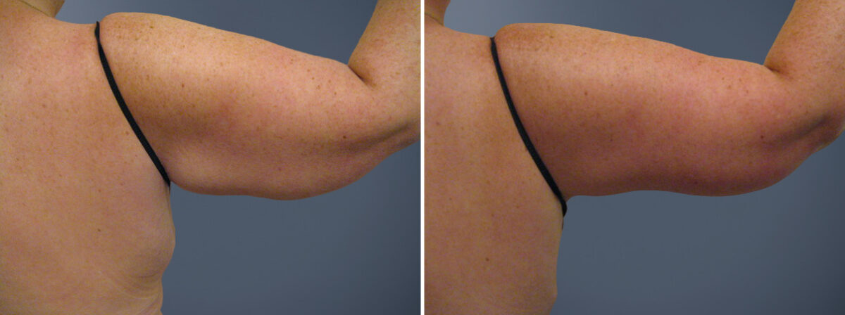 Before and after Arm Liposuction by Dr. David W. Allison, Patient 6159