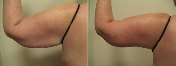 Before and after Arm Liposuction by Dr. David W. Allison, Patient 6159