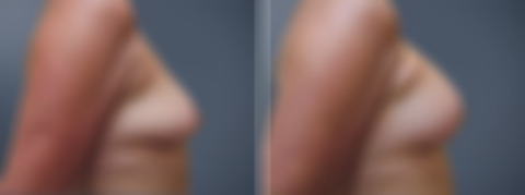 Before and after Breast Augmentation by Dr. David W. Allison, Patient 6173