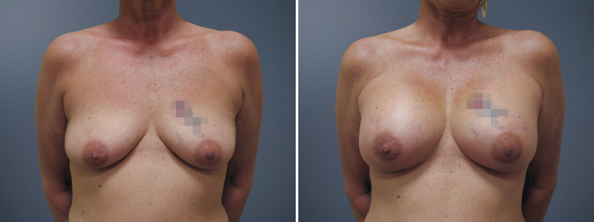Before and after Breast Augmentation by Dr. David W. Allison, Patient 6173