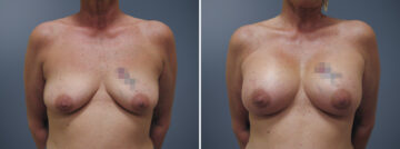 Before and after Breast Augmentation by Dr. David W. Allison, Patient 6173