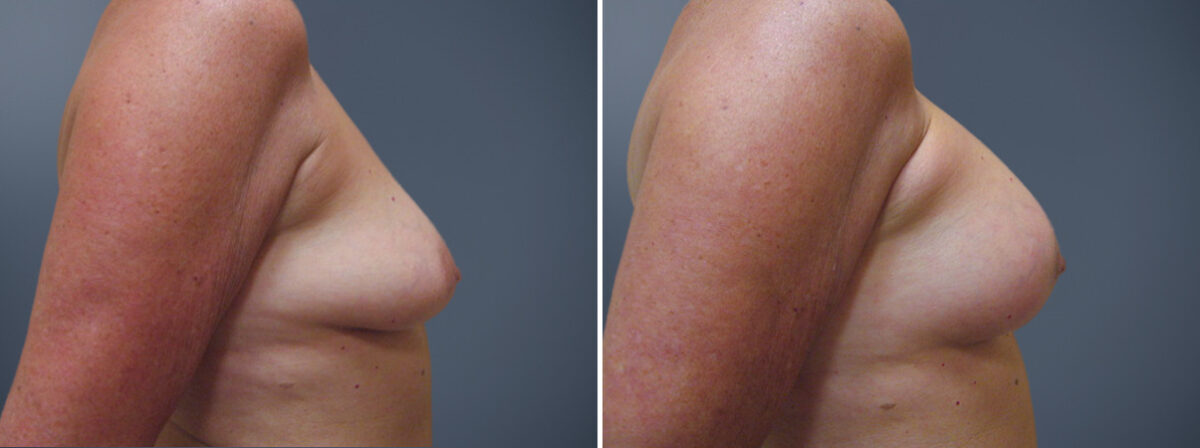 Before and after Breast Augmentation by Dr. David W. Allison, Patient 6173