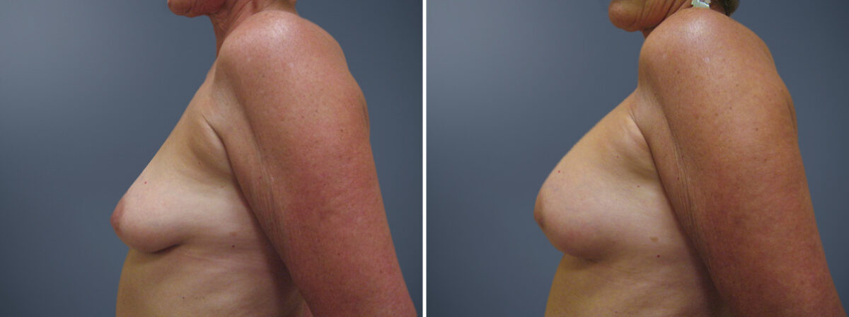Before and after Breast Augmentation by Dr. David W. Allison, Patient 6173