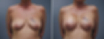 Before and after Breast Augmentation by Dr. David W. Allison, Patient 6173