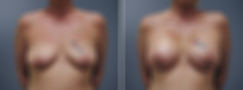 Before and after Breast Augmentation by Dr. David W. Allison, Patient 6173