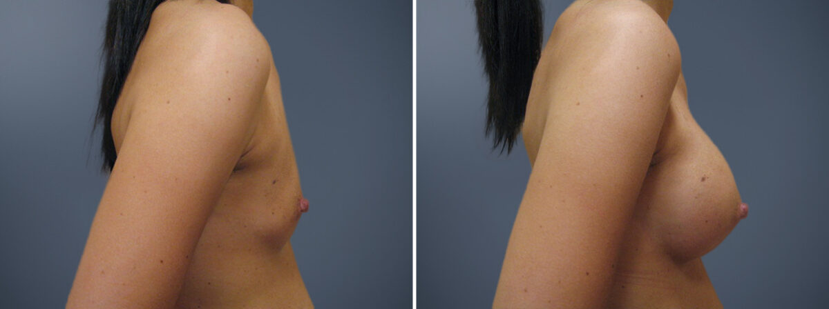 Before and after Breast Augmentation by Dr. David W. Allison, Patient 6194