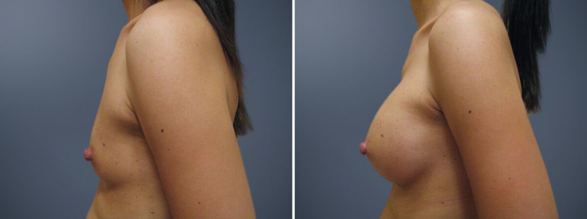Before and after Breast Augmentation by Dr. David W. Allison, Patient 6194