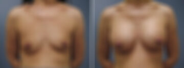Before and after Breast Augmentation by Dr. David W. Allison, Patient 6194