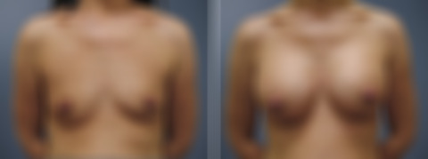 Before and after Breast Augmentation by Dr. David W. Allison, Patient 6194
