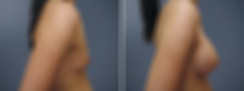 Before and after Breast Augmentation by Dr. David W. Allison, Patient 6194