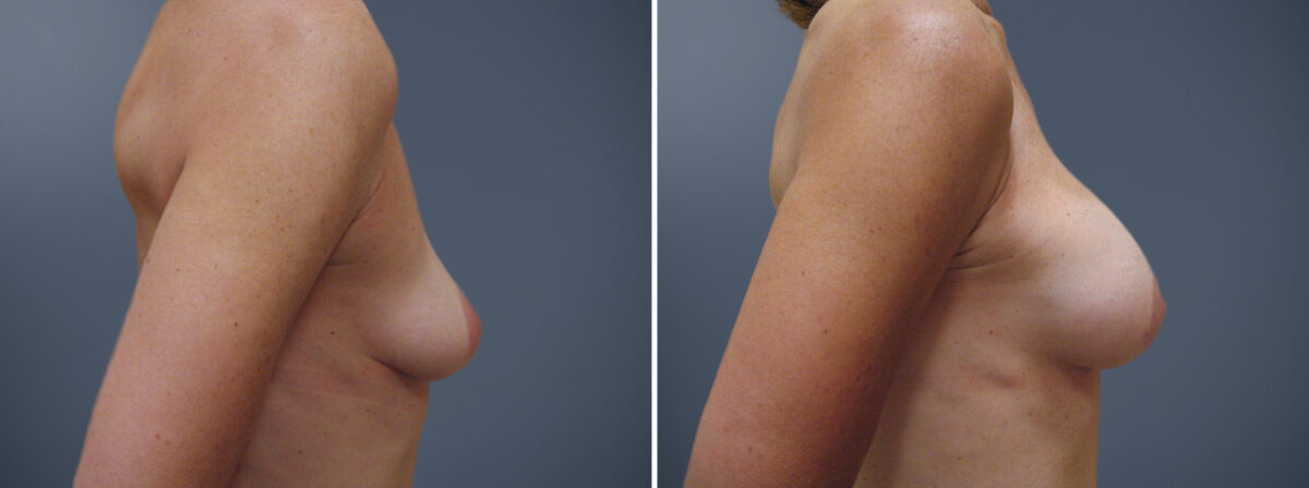 Before and after Breast Augmentation by Dr. David W. Allison, Patient 6204