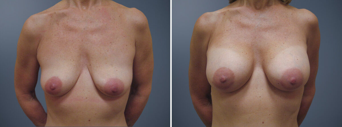 Before and after Breast Augmentation by Dr. David W. Allison, Patient 6204