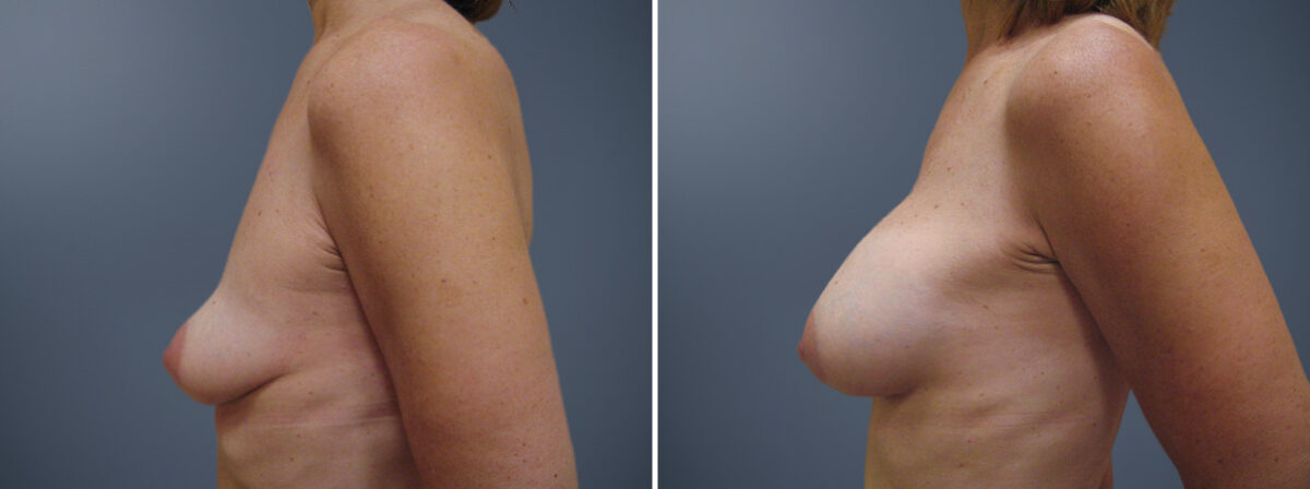 Before and after Breast Augmentation by Dr. David W. Allison, Patient 6204