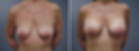 Before and after Breast Augmentation by Dr. David W. Allison, Patient 6204