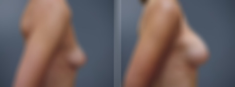 Before and after Breast Augmentation by Dr. David W. Allison, Patient 6204