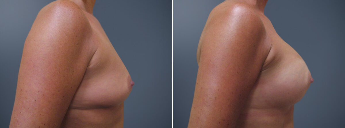 Before and after Breast Augmentation by Dr. David W. Allison, Patient 6214