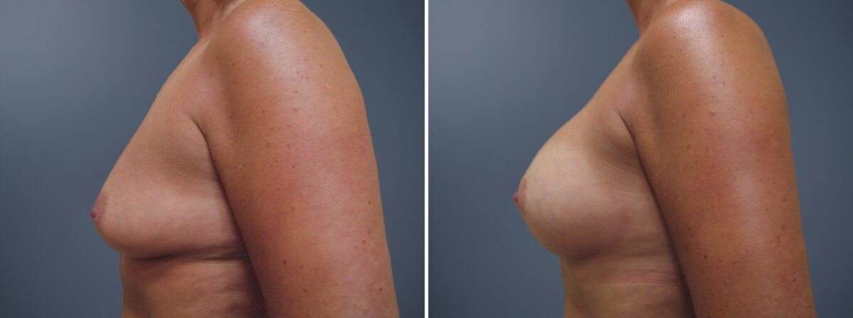 Before and after Breast Augmentation by Dr. David W. Allison, Patient 6214