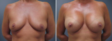 Before and after Breast Augmentation by Dr. David W. Allison, Patient 6214