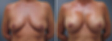 Before and after Breast Augmentation by Dr. David W. Allison, Patient 6214