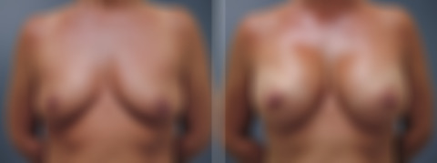 Before and after Breast Augmentation by Dr. David W. Allison, Patient 6214