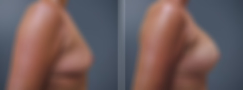 Before and after Breast Augmentation by Dr. David W. Allison, Patient 6214