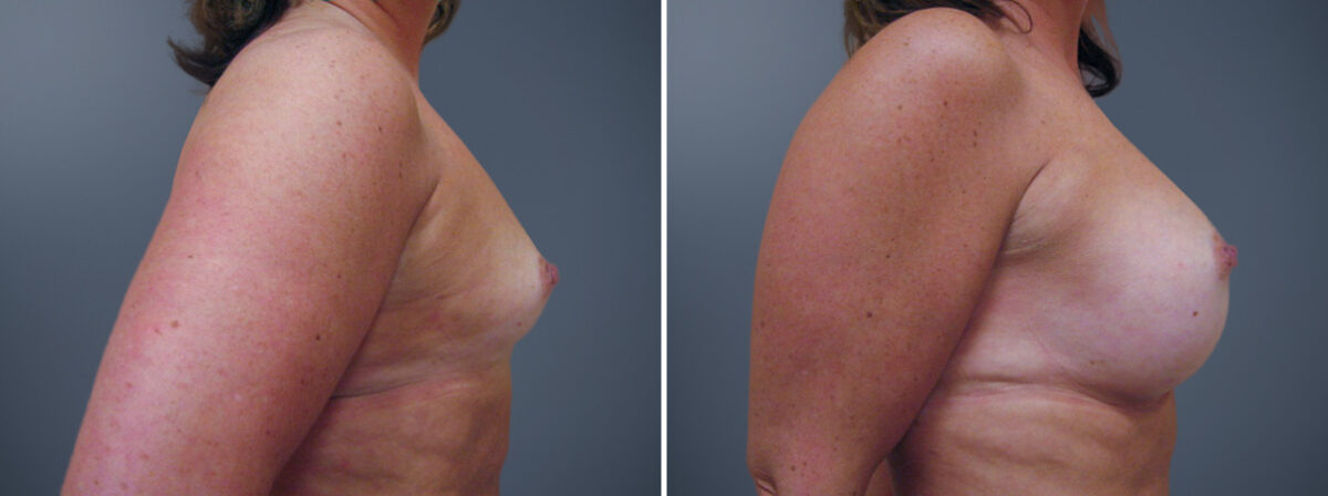 Before and after Breast Augmentation by Dr. David W. Allison, Patient 6225