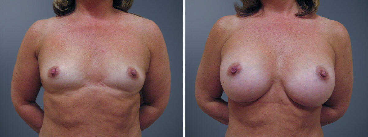 Before and after Breast Augmentation by Dr. David W. Allison, Patient 6225