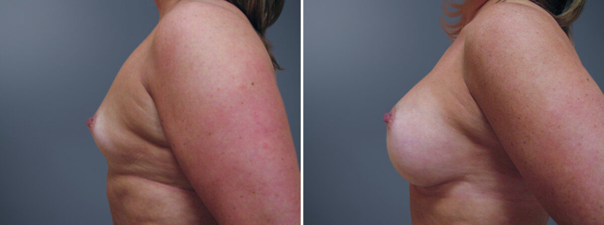 Before and after Breast Augmentation by Dr. David W. Allison, Patient 6225