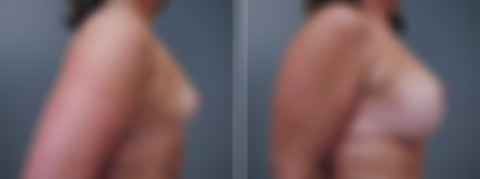 Before and after Breast Augmentation by Dr. David W. Allison, Patient 6225