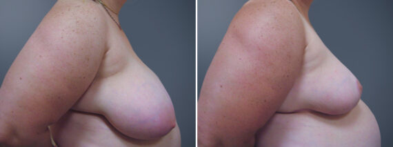 Before and after Breast Reduction by Dr. David W. Allison, Patient 6235