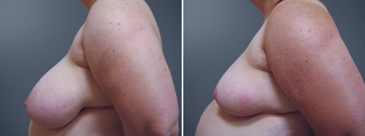 Before and after Breast Reduction by Dr. David W. Allison, Patient 6235