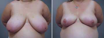 Before and after Breast Reduction by Dr. David W. Allison, Patient 6235