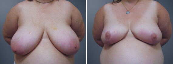 Breast Reduction before and after photos in Princeton, NJBreast Reduction Before and After Photos in Princeton, NJ