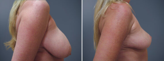 Before and after Breast Reduction by Dr. David W. Allison, Patient 6245