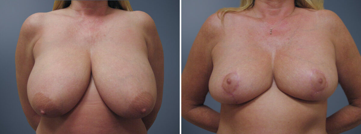 Before and after Breast Reduction by Dr. David W. Allison, Patient 6245