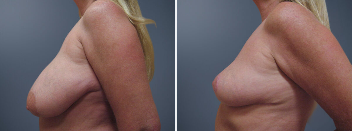 Before and after Breast Reduction by Dr. David W. Allison, Patient 6245