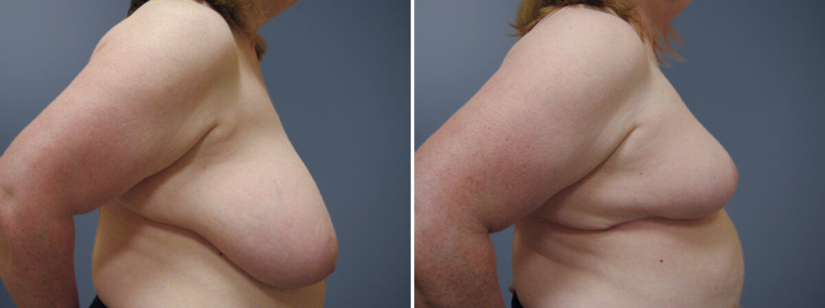 Before and after Breast Reduction by Dr. David W. Allison, Patient 6255