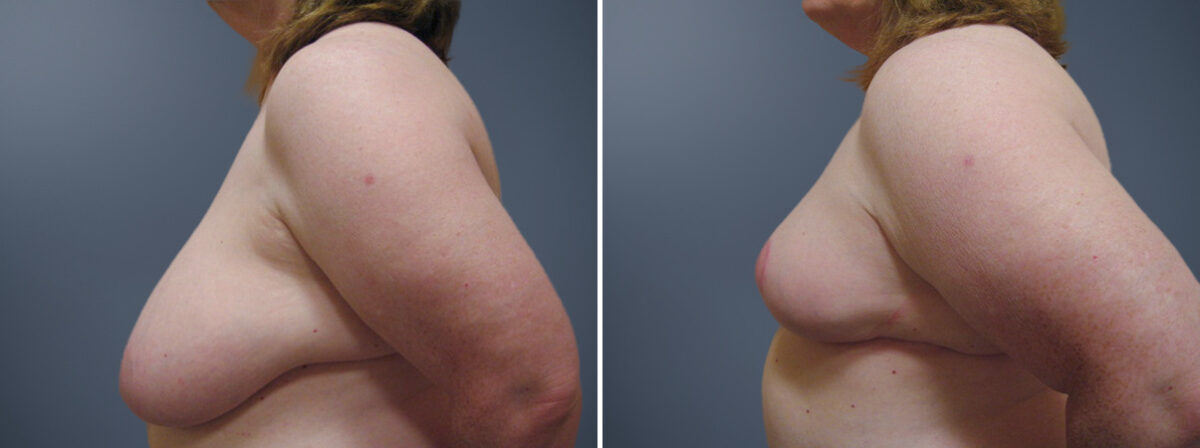 Before and after Breast Reduction by Dr. David W. Allison, Patient 6255