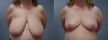 Before and after Breast Reduction by Dr. David W. Allison, Patient 6255