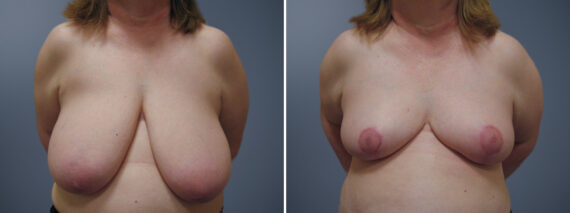Breast Reduction before and after photos in Princeton, NJBreast Reduction Before and After Photos in Princeton, NJ