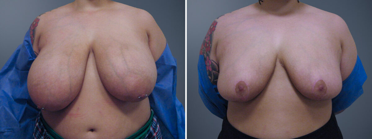 Before and after Breast Reduction by Dr. David W. Allison, Patient 6290